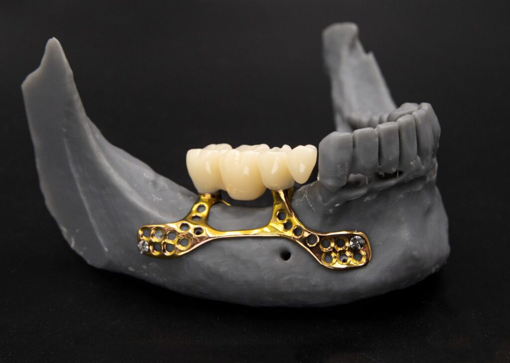 Subperiosteal Implant: Definition, Benefits, and Modern Use in Dentistry